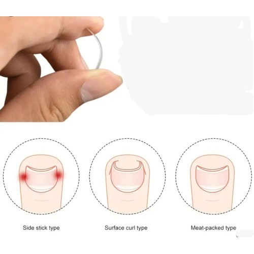 Batık Tırnak Düzeltici Aparat 